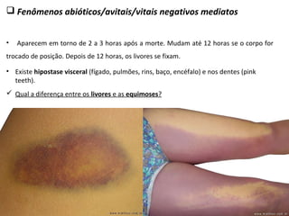  Fenômenos abióticos/avitais/vitais negativos mediatos
• Aparecem em torno de 2 a 3 horas após a morte. Mudam até 12 horas se o corpo for
trocado de posição. Depois de 12 horas, os livores se fixam.
 Qual a diferença entre os livores e as equimoses?
• Existe hipostase visceral (fígado, pulmões, rins, baço, encéfalo) e nos dentes (pink
teeth).
 