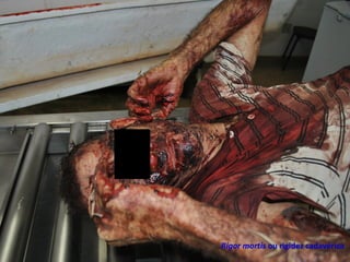 Rigor mortis ou rigidez cadavérica
 