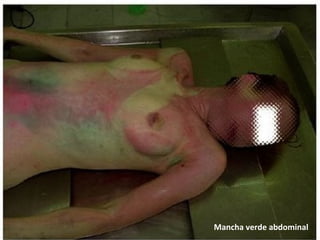 Mancha verde abdominal
 