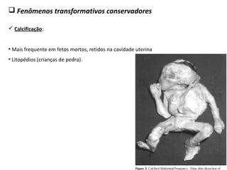  Fenômenos transformativos conservadores
 Calcificação:
• Mais frequente em fetos mortos, retidos na cavidade uterina
• Litopédios (crianças de pedra).
 