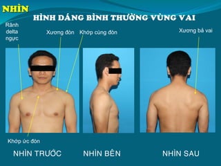 NHÌN SAUNHÌN BEÂNNHÌN TRÖÔÙC
HÌNH DAÙNG BÌNH THÖÔØNG VUØNG VAI
Xương đòn Khớp cùng đòn
Khớp ức đòn
Rãnh
delta
ngực
NHÌN
Xương bả vai
 