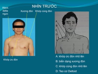 Khớp ức đòn
Xương đòn Khớp cùng đòn
Rãnh
delta
ngực
NHÌN TRƯỚC
A: khớp ức đòn nhô lên
B: biến dạng xương đòn
C: khớp cùng đòn nhô lên
D: Teo cơ Deltoid
 