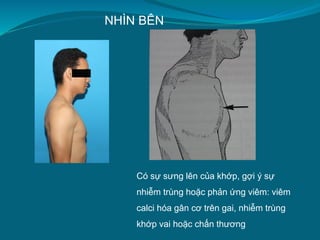 NHÌN BÊN
Có sự sưng lên của khớp, gợi ý sự
nhiễm trùng hoặc phản ứng viêm: viêm
calci hóa gân cơ trên gai, nhiễm trùng
khớp vai hoặc chấn thương
 