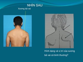 NHÌN SAU
Hình dạng và vị trí của xương
bả vai có bình thường?
Xương bả vai
 