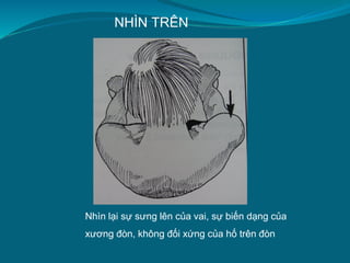 NHÌN TRÊN
Nhìn lại sự sưng lên của vai, sự biến dạng của
xương đòn, không đối xứng của hố trên đòn
 
