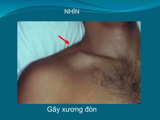 Gãy xương đòn
NHÌN
 