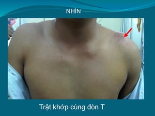 Trật khớp cùng đòn T
NHÌN
 