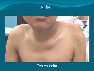 Teo cơ delta
NHÌN
 