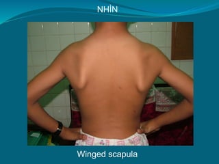 Winged scapula
NHÌN
 
