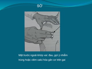 SỜ
Mặt trước ngoài khớp vai: đau, gợi ý nhiễm
trùng hoặc viêm calci hóa gân cơ trên gai
 
