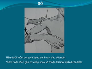 SỜ
Bên dưới mỏm cùng và dạng cánh tay: đau đột ngột
Viêm hoặc rách gân cơ chóp xoay và /hoặc túi hoạt dịch dưới delta
 