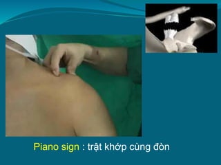 Piano sign : trật khớp cùng đòn
 