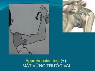 Apprehension test (+):
MẤT VỮNG TRƯỚC VAI
 