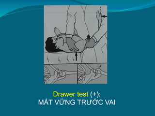 Drawer test (+):
MẤT VỮNG TRƯỚC VAI
 