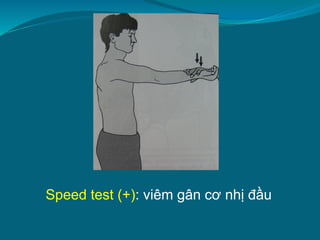Speed test (+): viêm gân cơ nhị đầu
 