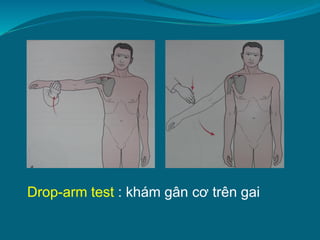 Drop-arm test : khám gân cơ trên gai
 
