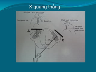 X quang thẳng
 