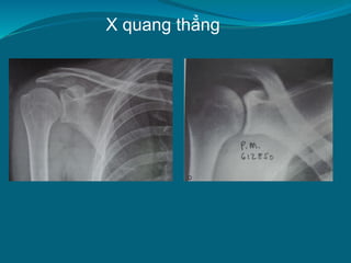 X quang thẳng
 
