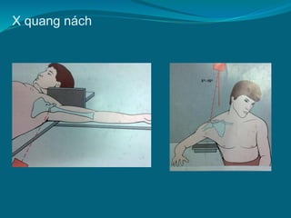X quang nách
 