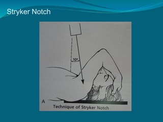 Stryker Notch
 