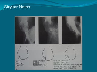 Stryker Notch
 