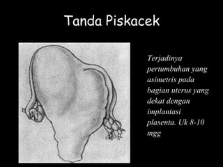 Tanda Piskacek
Terjadinya
pertumbuhan yang
asimetris pada
bagian uterus yang
dekat dengan
implantasi
plasenta. Uk 8-10
mgg
 