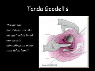 Tanda Goodell’s
Perubahan
konsistensi serviks
menjadi lebih lunak
dan kenyal
dibandingkan pada
saat tidak hamil
 