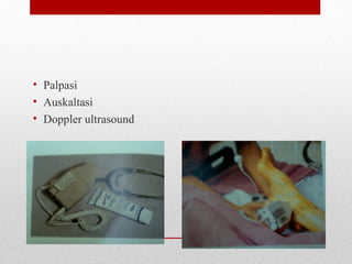 MENGAMBIL NADI
• Palpasi
• Auskaltasi
• Doppler ultrasound
 