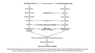 Kirkaldy-Willis schematic demonstrating a proposed mechanism for disc and facet degeneration. (From Kirkaldy-Willis WH, Wedge JH, Yong-Hing
K, Reilly J. Pathology and pathogenesis of lumbar spondylosis and stenosis. Spine 1978;3:319–328. Reprinted with permission.)
 