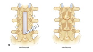 Laminectomy Laminotomy
 