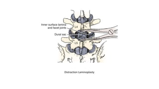 Distraction Laminoplasty
 