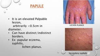 PAPULE
LICHEN PLANUS
Secondary syphilis
• It is an elevated Palpable
lesion,
arbitrarily <0.5cm in
diameter.
• Can have distinct/indistinct
borders.
• Ex: papular eczema,
syphilis,
lichen planus.
 