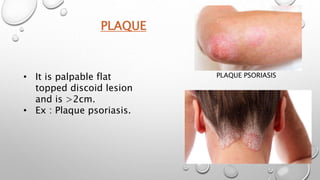 PLAQUE
PLAQUE PSORIASIS
• It is palpable flat
topped discoid lesion
and is >2cm.
• Ex : Plaque psoriasis.
 