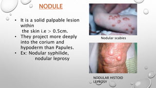 NODULE
• It is a solid palpable lesion
within
the skin i.e > 0.5cm.
• They project more deeply
into the corium and
hypoderm than Papules.
• Ex: Nodular syphilide,
nodular leprosy
Nodular scabies
NODULAR HISTOID
LEPROSY
 