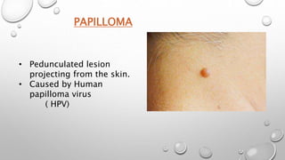 PAPILLOMA
• Pedunculated lesion
projecting from the skin.
• Caused by Human
papilloma virus
( HPV)
 