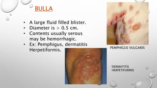 BULLA
• A large fluid filled blister.
• Diameter is > 0.5 cm.
• Contents usually serous
may be hemorrhagic.
• Ex: Pemphigus, dermatitis
Herpetiformis.
PEMPHIGUS VULGARIS
DERMATITIS
HERPETIFORMIS
 