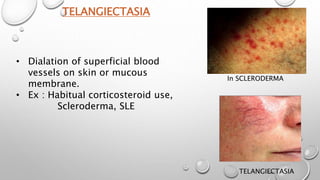TELANGIECTASIA
• Dialation of superficial blood
vessels on skin or mucous
membrane.
• Ex : Habitual corticosteroid use,
Scleroderma, SLE
In SCLERODERMA
TELANGIECTASIA
 