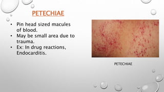 PETECHIAE
PETECHIAE
• Pin head sized macules
of blood.
• May be small area due to
trauma.
• Ex: In drug reactions,
Endocarditis.
 