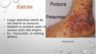 PURPURA
• Larger petechiae which do
not blanch on pressure.
• Reddish or purplish spots of
various sizes and shapes.
• Ex : Vasciculitis, in clotting
defects.
VASCICULITIS
 