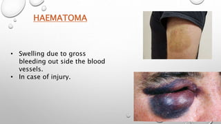 HAEMATOMA
• Swelling due to gross
bleeding out side the blood
vessels.
• In case of injury.
 