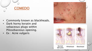 COMEDO
• Commonly known as blackheads.
• Dark horny keratin and
sebaceous plugs within
Pilosebaceous opening.
• Ex : Acne vulgaris
 