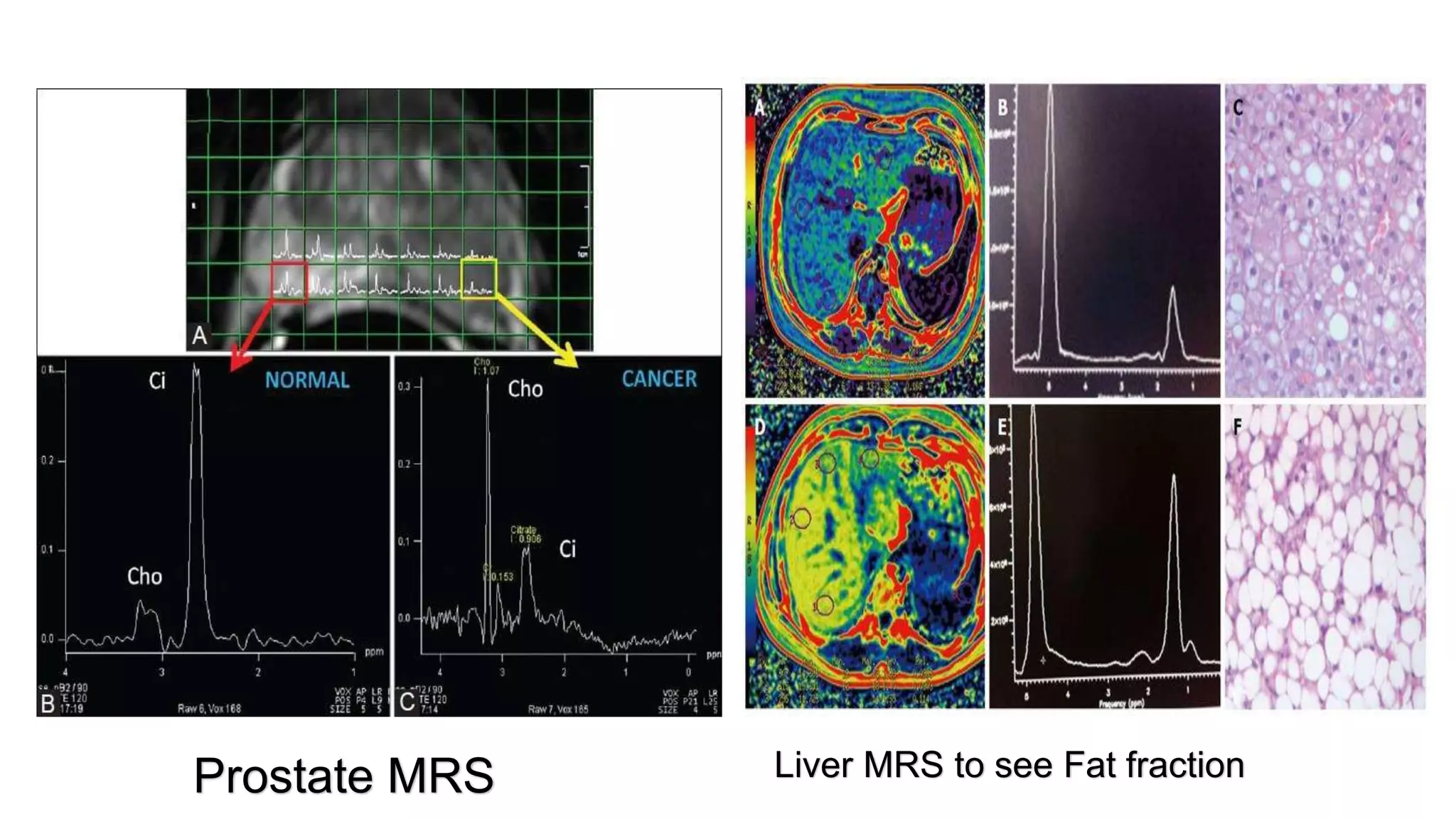 Prostate MRS Liver MRS to see Fat fraction
 