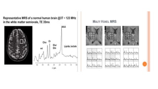 Basic physics and normal interpretation of MRS | PPTX