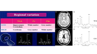 Mrs. Brain Example Basic physics and normal interpretation of MRS | PPTX