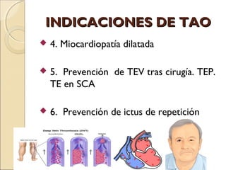 INDICACIONES DE TAOINDICACIONES DE TAO
 4. Miocardiopatía dilatada
 5. Prevención de TEV tras cirugía. TEP.
TE en SCA
 ...