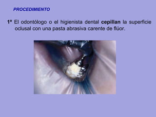 1º El odontólogo o el higienista dental cepillan la superficie
oclusal con una pasta abrasiva carente de flúor.
PROCEDIMIENTO
 