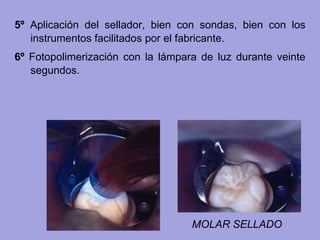 5º Aplicación del sellador, bien con sondas, bien con los
instrumentos facilitados por el fabricante.
6º Fotopolimerización con la lámpara de luz durante veinte
segundos.
MOLAR SELLADO
 