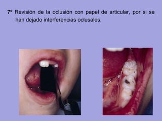7º Revisión de la oclusión con papel de articular, por si se
han dejado interferencias oclusales.
 