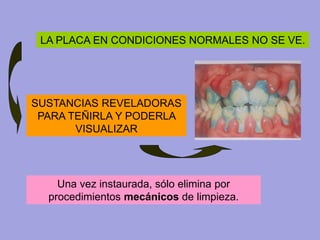 LA PLACA EN CONDICIONES NORMALES NO SE VE.
SUSTANCIAS REVELADORAS
PARA TEÑIRLA Y PODERLA
VISUALIZAR
Una vez instaurada, sólo elimina por
procedimientos mecánicos de limpieza.
 