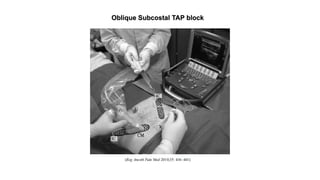 Oblique Subcostal TAP block
 